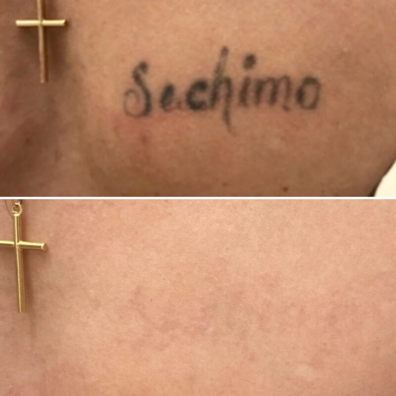 Laser Tattoo Removal DEA Med Spa in Glendale CA