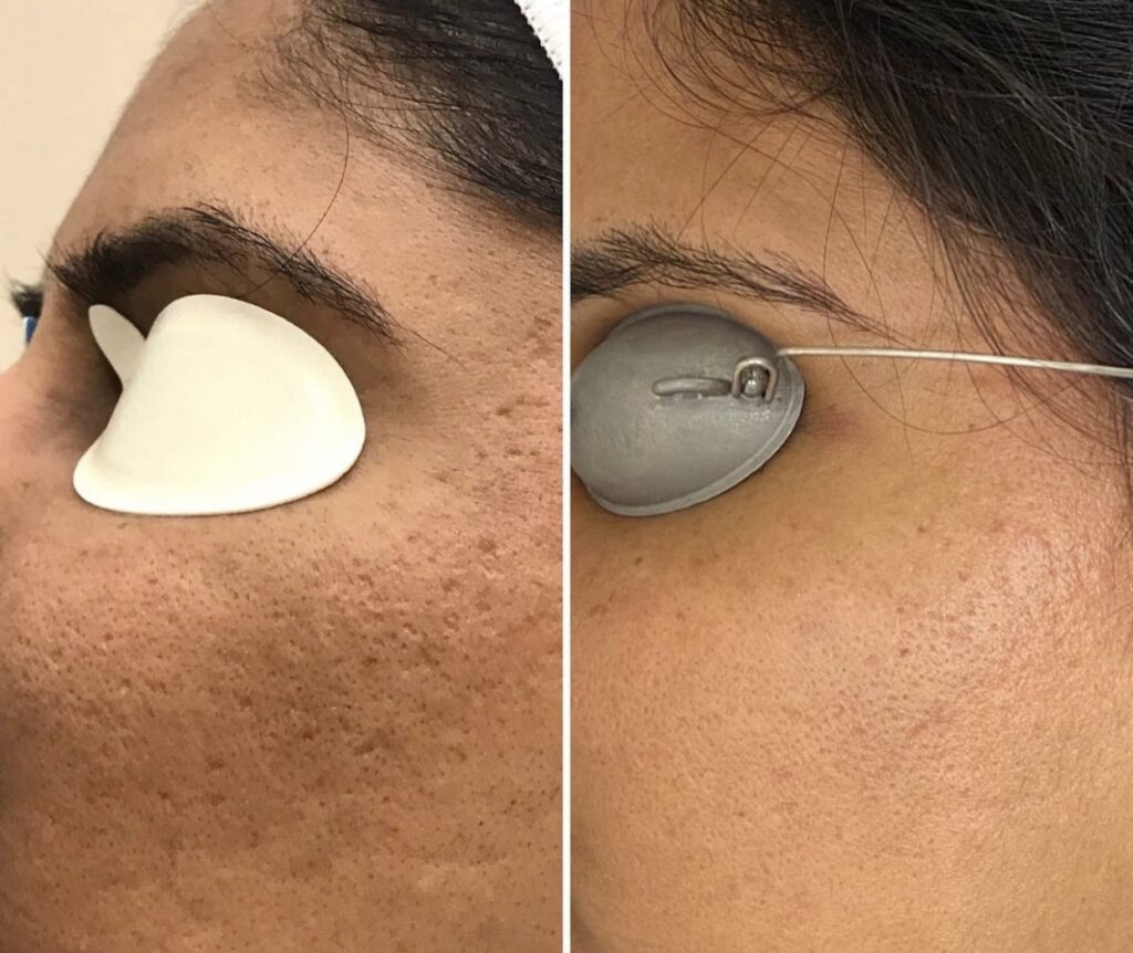 Laser Scar Treatments DEA Med Spa in Glendale CA