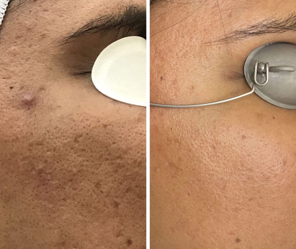 Laser Scar Treatments DEA Med Spa in Glendale CA